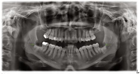 Coronectomy