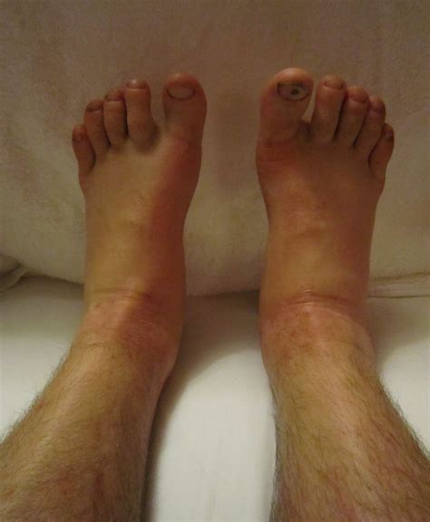Benign Causes of Both Ankles Being Swollen & Puffy and Treatment ...