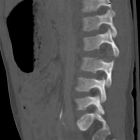 Lumbar Spine Sagittal