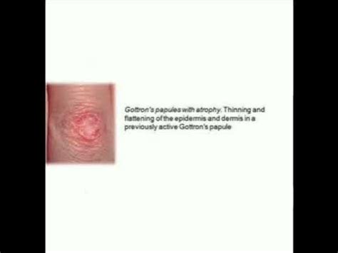 DERMATOMYOSITIS Sign ( Gottron' papule , Shawl sign , Heliottope rash ) - YouTube