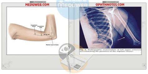 Management of Missed Implanon | Implanon removal, Management, Obstetrics