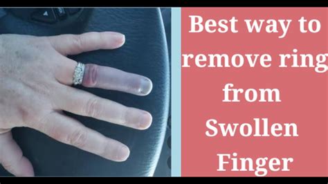 Remove stuck ring from swollen finger easy & effective way / Life hack-remove ring in 1 minute ...