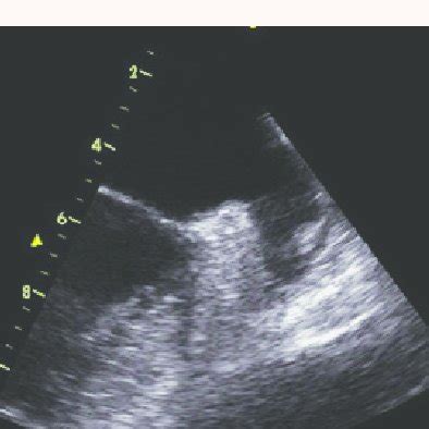 Thrombus identified with in the left atrial appendage during TOE ...