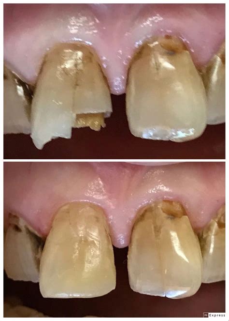 BEFORE AND AFTER COSMETIC BONDING UPPER FRONT TOOTH