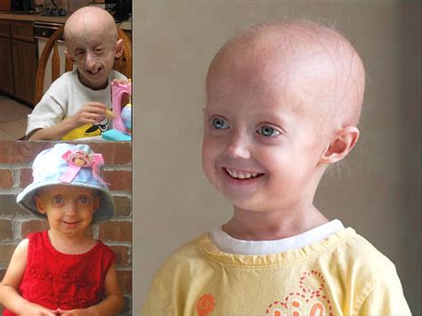 progeria syndrome ~ Christine O'Donnell