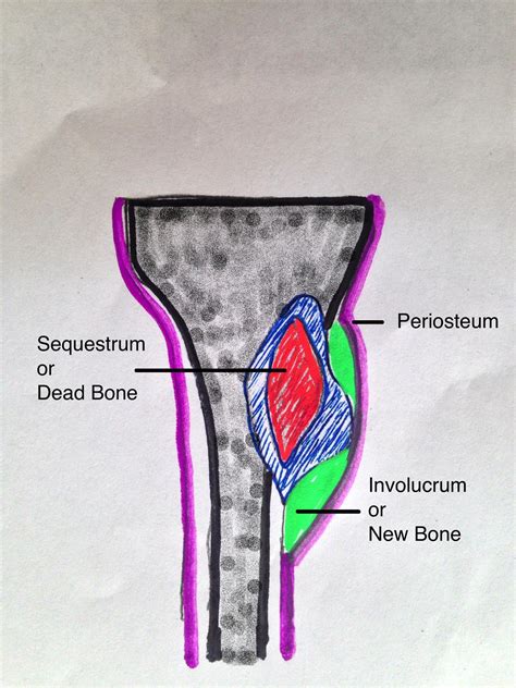 Osteomyelitis - Pediatric - Pediatrics - Orthobullets