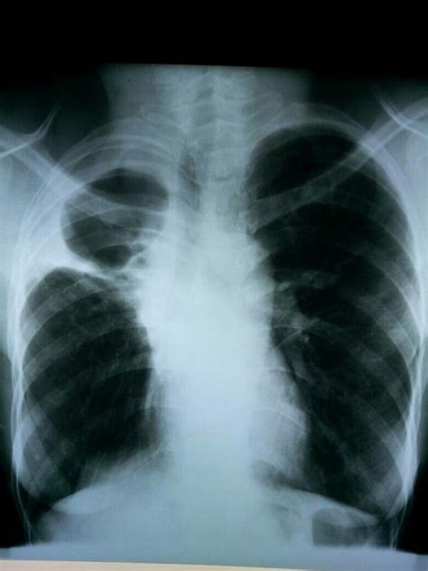 Loculated pleural effusion | Medical ultrasound, Radiology, Radiography