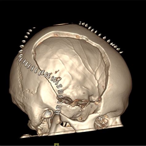 A brain computed tomography scan illustrating right decompressive ...