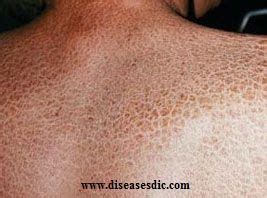 Ichthyosis - Causes, Risk factors, and Treatment.