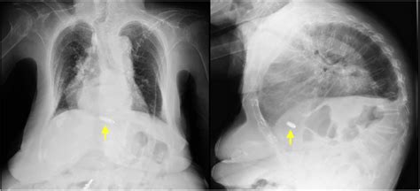 Chest X-rays after the leadless pacemaker implantation in the... | Download Scientific Diagram