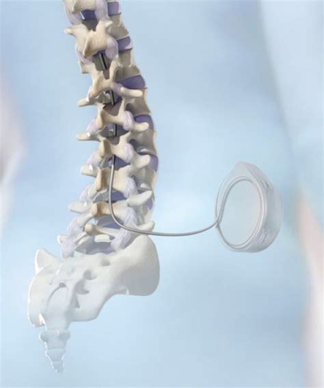 SCI: Spinal Cord Injury -Inthrathecal Baclofen Pump Experience Part 3