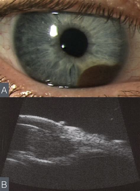 Retina Today - Updated Classification for Primary Iris Melanoma (July ...