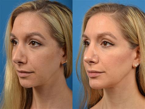 Rhinoplasty Photos | Melbourne, FL | Patient 56566