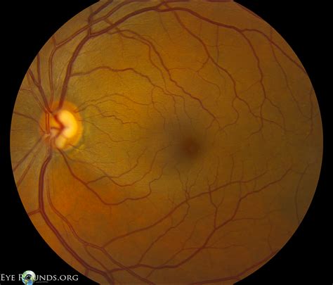 Atlas Entry - Optic Disc Notch and Retinal Nerve Fiber Layer Defect in Primary Open Angle Glaucoma