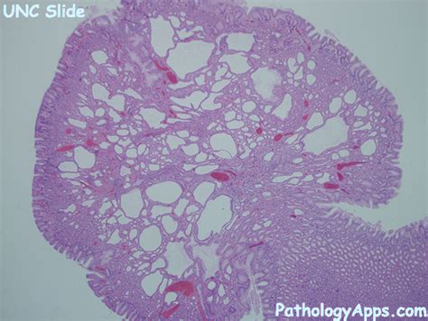 fundic gland polyp pathology