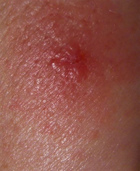 Ticked off | Tick bite, Very, very itchy, and several days o… | Christine McIntosh | Flickr