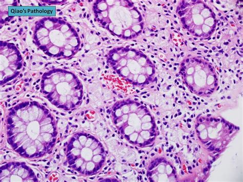 Pathology Outlines - Xanthoma