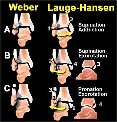 Ankle fracture - Weber and Lauge-Hansen Classification | Ankle fracture, Radiology imaging ...