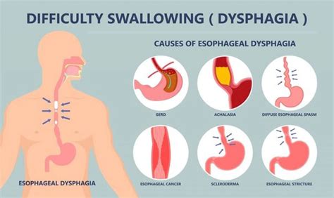 4 Critical Reasons For Difficulty Swallowing Starchy Foods?