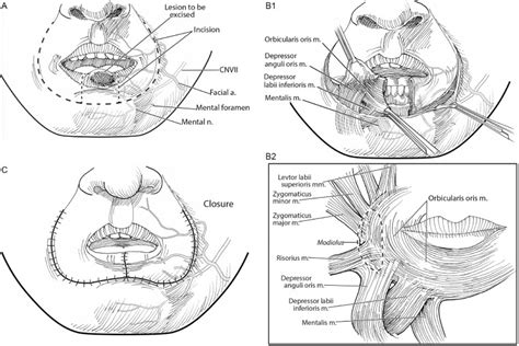 The Karapandzic flap - Operative Techniques in Otolaryngology-Head and ...