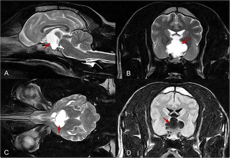 Frontiers | A Recurrent Suprapituitary Ependymal Cyst Managed by Endoscopy-Assisted ...