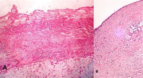 Pericardium showing extensive fibrinous exudate with inflammatory cell ...