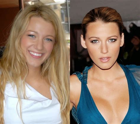 Celebrity: Blake Lively Plastic Surgery Before After Reports | The Glitter