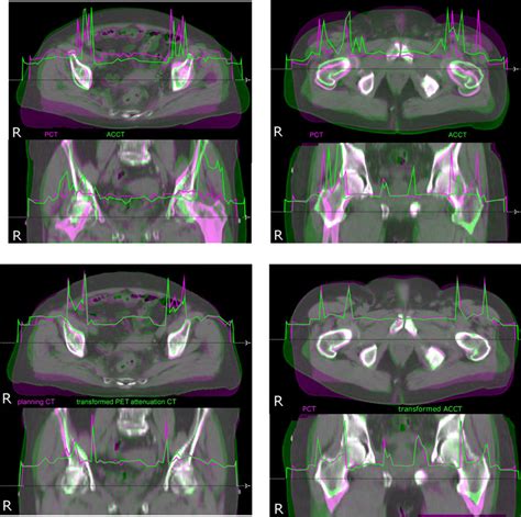 (a) Patient 1: untransformed attenuation correction CT used for PET ...