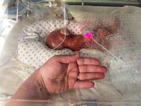 One Of Britain's 'Most Premature Babies' Defies Odds After Being Born ...