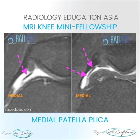 KNEE PLICA MRI MEDIAL PATELLAR PLICA RADIOLOGY - Radedasia