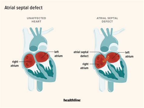 Atrial Septal Defect: Definition, Causes, Treatment, Outlook