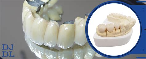 PFM crowns | Dave Johnson Dental Laboratory