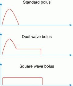 Advanced Pump Functions: Bolus Calculator, Bolus Types, and Temporary ...