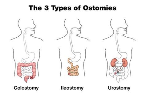 A Guide to Ostomy and Stoma Care - Homage Malaysia