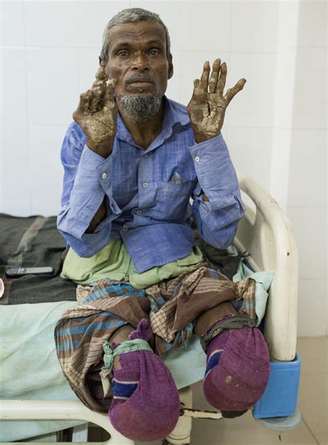 Tree men found suffering from condition which turns their skin into 'bark' | Daily Star