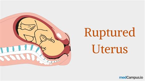 Causes and Treatment of Ruptured Uterus - YouTube