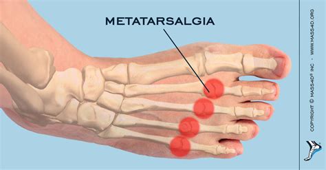 Causes and Symptoms of Metatarsalgia | MASS4D® Insoles - MASS4D® Foot ...