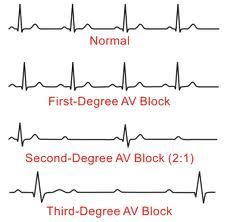 Complete Congenital Heart Block - Lily's Heart Warriors