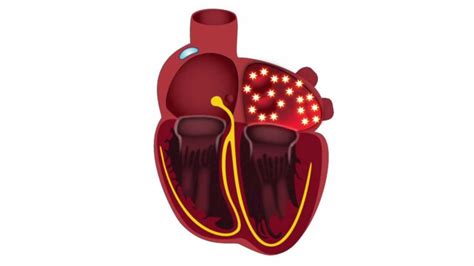 Why you have to Take Blood Thinners for Atrial Fibrillation ...