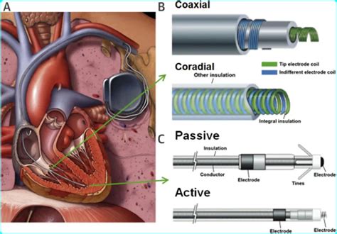 What is Wandering Atrial Pacemaker Best Way- AR Medical Technology 24