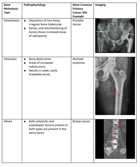 Bone Metastases – Diagnosis & Treatment : Emergency Care BC