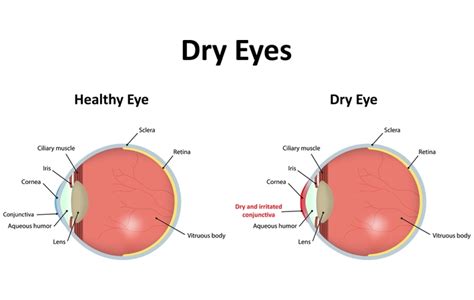 Can Dry Eyes Cause Headaches? | Abbotsford