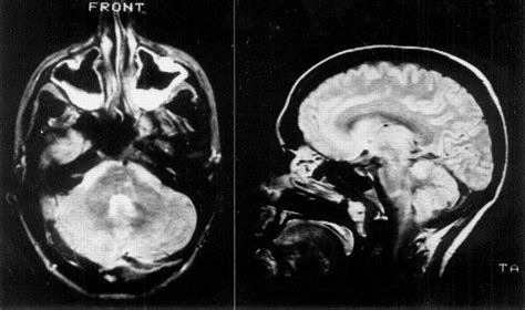 Cranial Nerve Palsy Mri