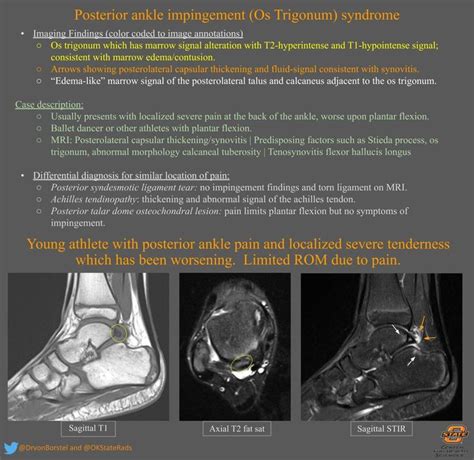 Posterior Ankle Impingement (Os Trigonum) Syndrome ...