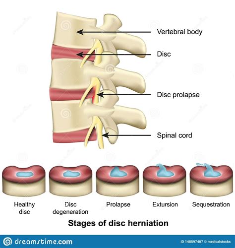 Types Of Lumbar Disc Herniation