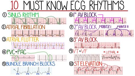 Most Common ECG Patterns You Should Know - YouTube