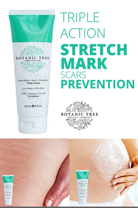 Best stretch marks cream