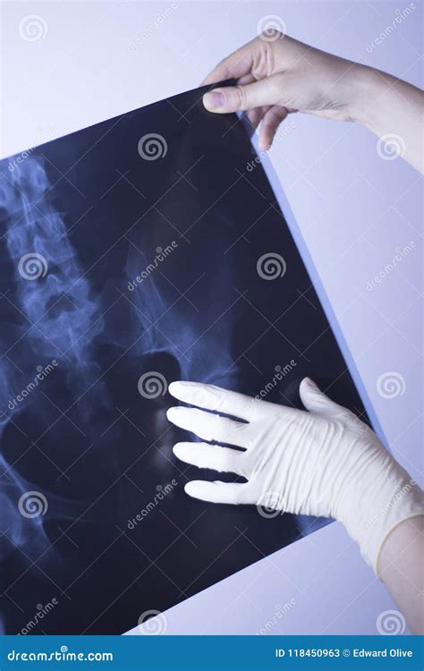 Medical Xray Spine Hip Scan Stock Image - Image of dislocation, science: 118450963