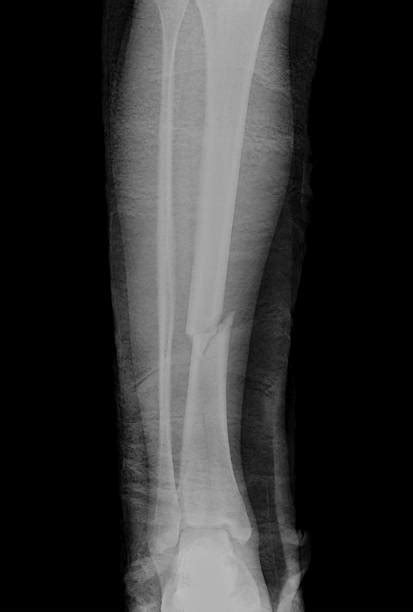 Best Broken Leg Xray Stock Photos, Pictures & Royalty-Free Images - iStock