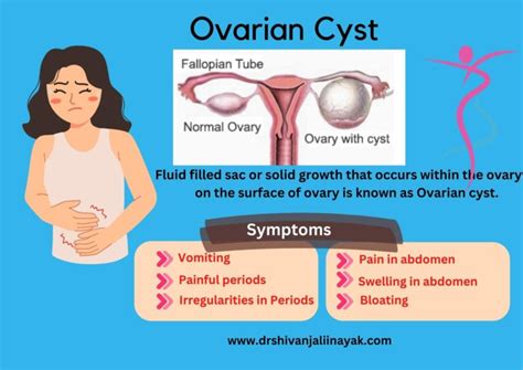 What is Ovarian Cyst and what are its symptoms and treatments? Dr Shivanjali Nayak , Top ...